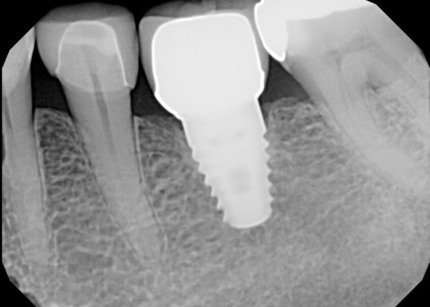 An implant replacing a single 
