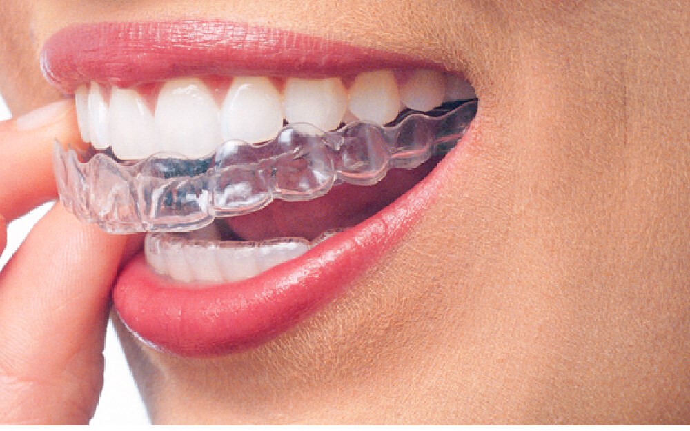 pros-benefits-invisalign
