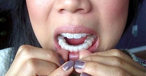 invisalign-cons